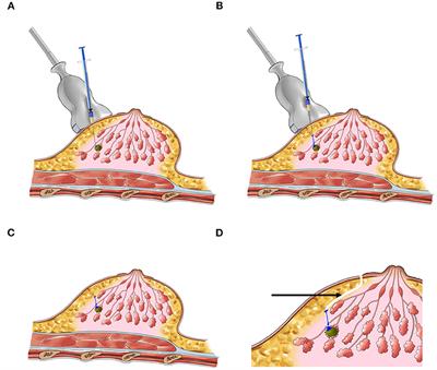 Evaluation of Carbon Nanoparticle Suspension and Methylene Blue Localization for Preoperative Localization of Nonpalpable Breast Lesions: A Comparative Study